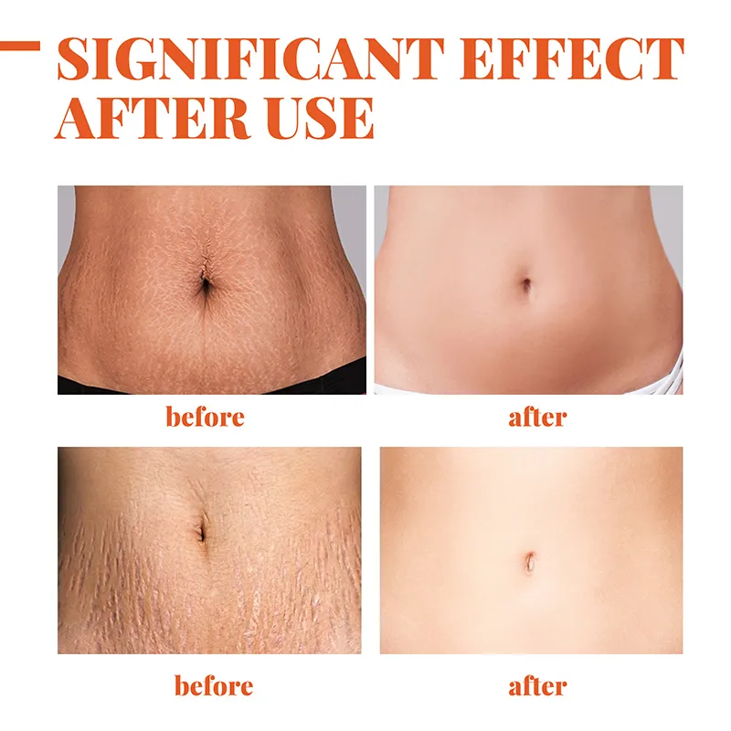 Maternity Scar Repair Essential Oil Pregnancy Lift Stretch Mark Remove Enhance Skin Care Elasticity Firm Sagging Deep Moisturize Maternity Scar Repair Essential Oil Pregnancy Lift Stretch Mark Remove Enhance Skin Care Elasticity Firm Sagging Deep Moisturize